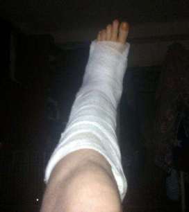 Złamana noga. fot. Krzysztof Chrola